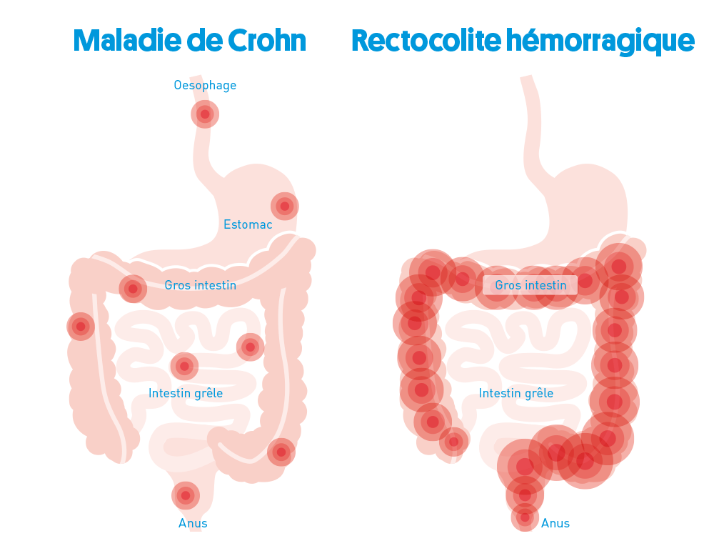 Les modÃ¨les dâinfestation possibles de la maladie dans le tractus gastro-intestinal dans le cas de la