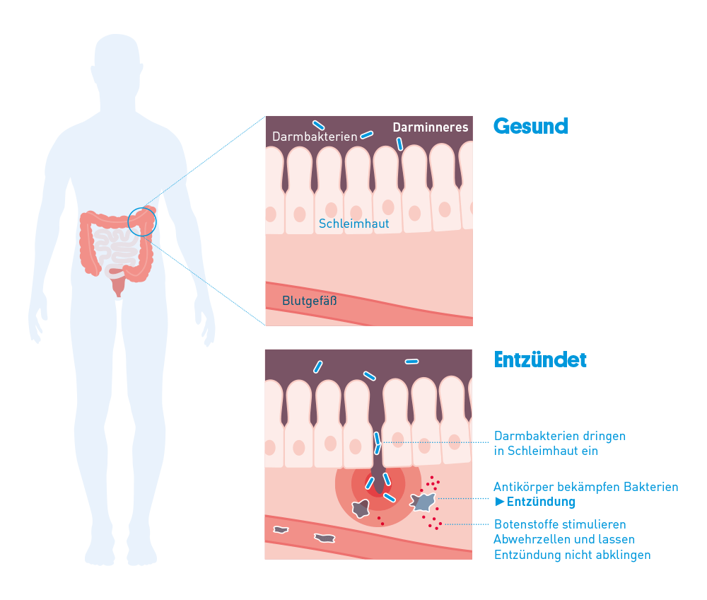 Beim Morbus Crohn erfasst die EntzÃ¼ndung alle Schichten der Darmwand.