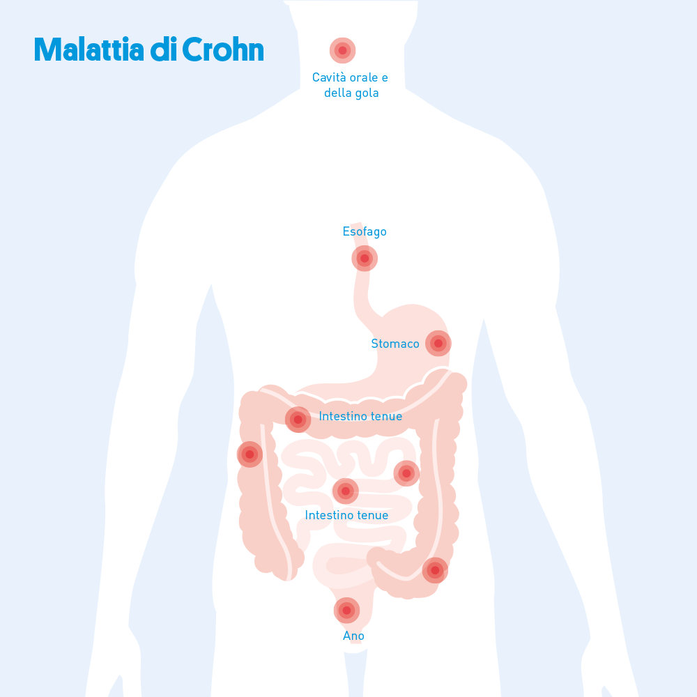 Il tratto gastrointestinale e il modello spesso segmentario in cui si presenta la malattia di Crohn: le aree sane si alternano a quelle infiammate. Una zona tipica Ã¨ il passaggio dall'intestino tenue all'intestino crasso.