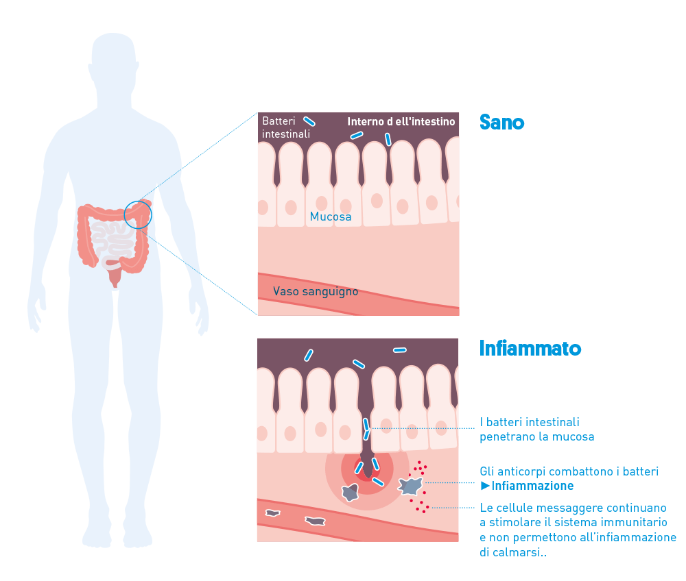 La colite ulcerosa Ã¨ un'infiammazione cronica del colon. A differenza della malattia di Crohn, l'infiammazione Ã¨ limitata agli strati delle mucose dell'intestino.