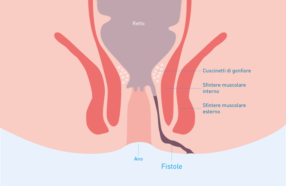 fistola perianale