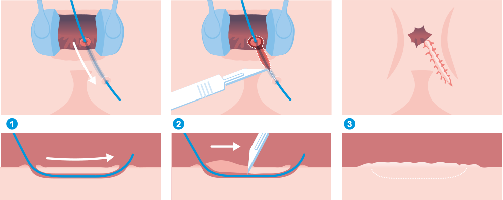 "Ãtape 1 : reprÃ©sentation du canal de fistule Ã  lâaide dâune sonde. Ãtape 2 : ouverture du canal de la fistule et retrait de lâouverture interne. Ãtape 3 : contours de la plaie suturÃ©s (marsupialisation)"