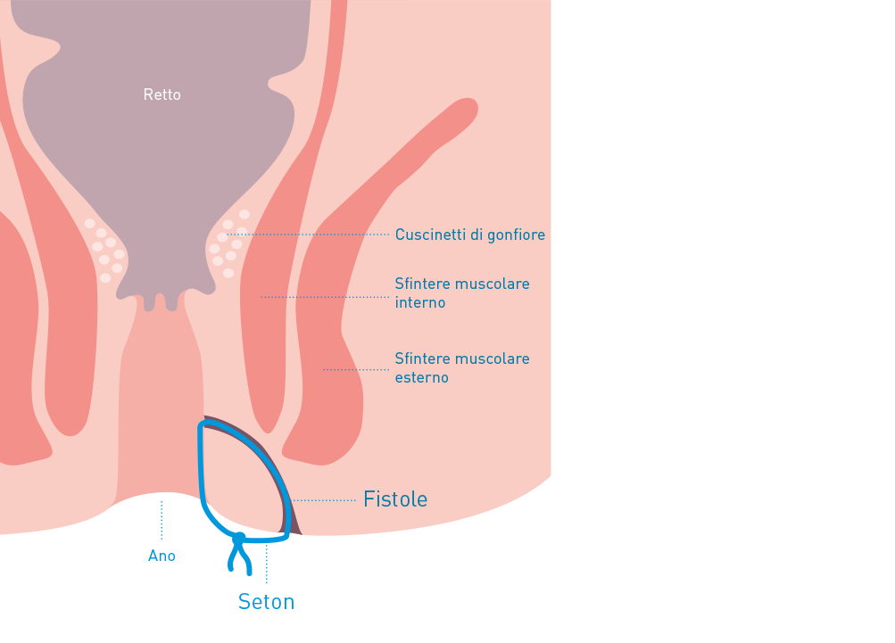 Il seton (filo di silicone o lembi di gomma) Ã¨ legato all'esterno dell'ano e rimane tale per 3-6 settimane. Questo garantisce un drenaggio permanente.