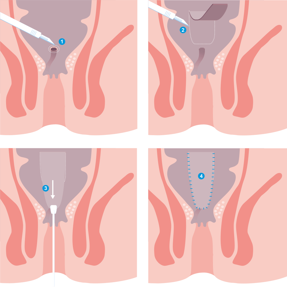 Tecnica del lembo mucoso